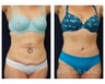 Abdominoplasty - Tummy Tuck