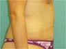 Tummy Tuck