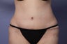 50 yr old wanting liposuction and a tummy tuck