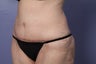 50 yr old wanting tummy tuck and liposuction