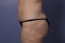 50 yr old wanting tummy tuck and liposuction