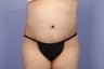 65 yr old wanting tummy tuck and liposuction