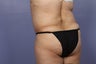 65 yr old wanting tummy tuck and liposuction