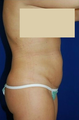 Tummy Tuck, liposuction
