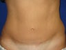Tummy Tuck