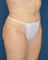 Tummy Tuck