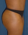 Tummy Tuck