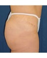 Tummy Tuck
