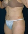 Tummy Tuck
