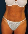 Tummy Tuck