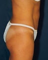Tummy Tuck