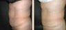 Abdominoplasty