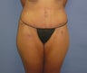 Tummy Tuck