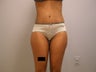 Tummy Tuck