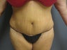 Tummy tuck