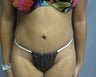 Tummy Tuck