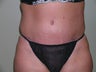 Tummy Tuck or Abdominoplasty