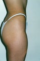 Tummy Tuck