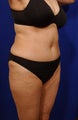 Tummy Tuck