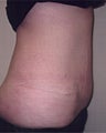 Tummy Tuck