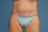 Tummy Tuck