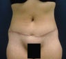 Tummy Tuck