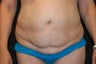 Tummy Tuck
