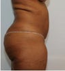 Abdominoplasty