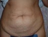 Tummy Tuck 
