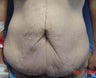 Tummy Tuck 