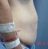 Tummy Tuck Before & After