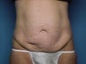 Tummy Tuck