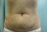 Tummy Tuck