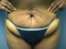 Tummy Tuck