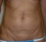 Tummy Tuck