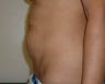 Tummy Tuck