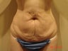 Tummy Tuck