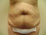 Tummy Tuck