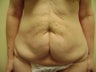 Tummy Tuck