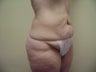 Tummy Tuck