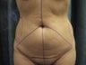 Tummy Tuck