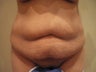 Tummy Tuck