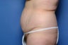 Tummy Tuck