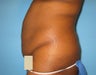 Tummy Tuck