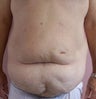 Tummy Tuck before and after