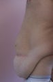 Tummy Tuck before and after