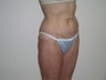 Abdominoplasty