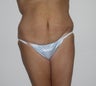 Abdominoplasty