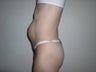 Tummy Tuck