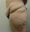 Tummy Tuck